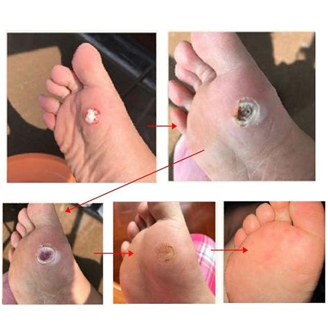 Wart Removal Patch - Painlessly Feet, Callus Cutins, Corn Remover Foot Care | Fruugo HU