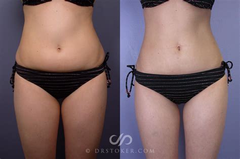 What Is Smart Lipo And How Much Does It Cost | Sitelip.org