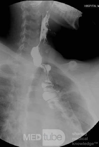 Colonic interposition for Esophageal Substitution (12 of 14) • Picture ...