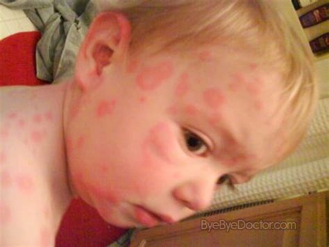 fifths disease rash pictures - pictures, photos