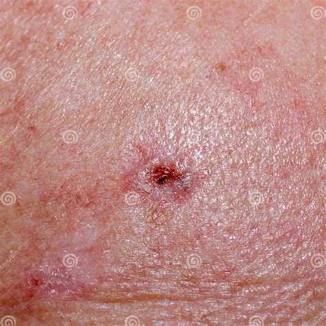 Solar Keratosis or Basalioma on Human Scalp Stock Image - Image of mole, scalp: 285360619