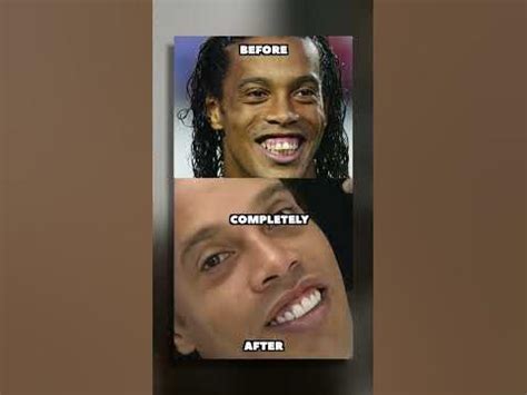 RONALDINHO AND RONALDO TEETH SURGERY #shorts - YouTube