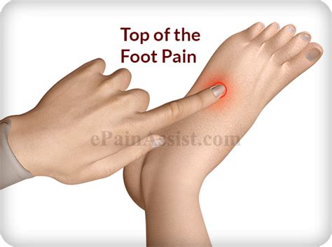 Top of the Foot Pain: Treatment, Exercises, Causes, Symptoms