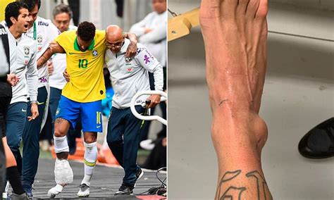 Neymar reveals shocking swollen ankle which ruled PSG star out of Brazil's Copa America campaign
