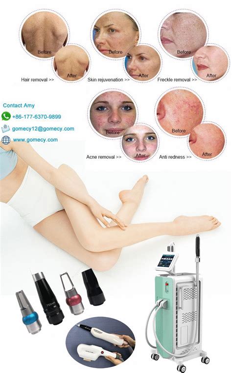 Hair Removal Device, Hair Removal Machine, Ipl Hair Removal, Pulse Light, Unwanted Facial Hair ...