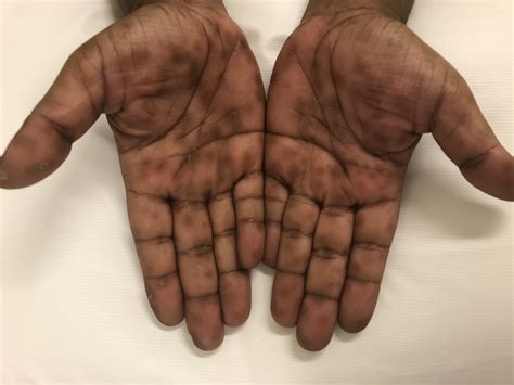 A Woman With a Rash on Her Palms and Soles | Consultant360