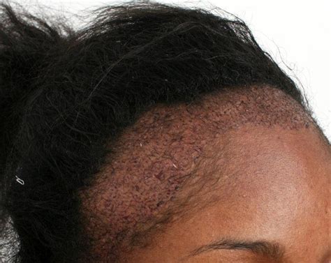 Traction Alopecia: Traction Alopecia Before And After Pictures