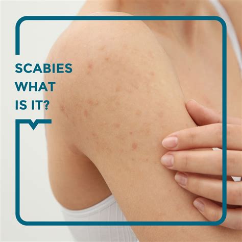 Scabies: symptoms, treatments, and prevention - Alegria Medical Centre