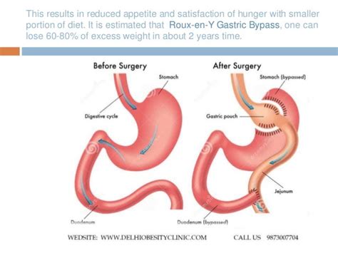 Roux En Y Gastric Bypass Surgery Complications Risks - vrogue.co