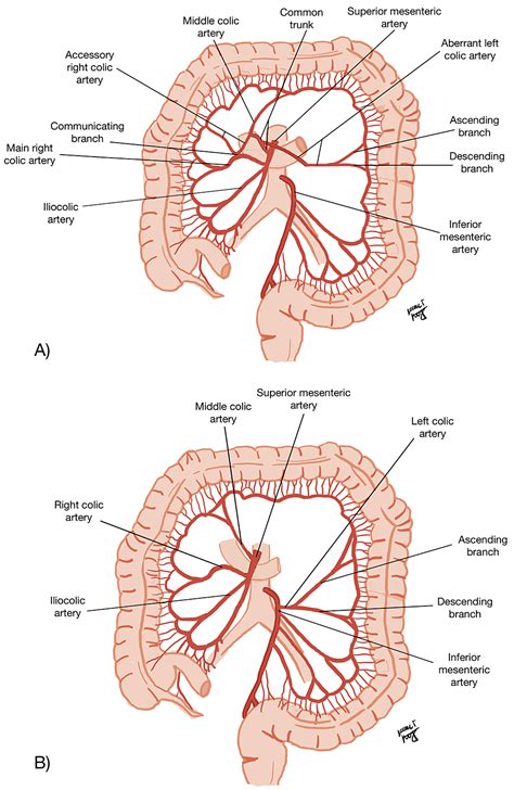 Aberrant Left Colic Artery and Accessory Right Colic Artery: A Case Report and Surgical ...