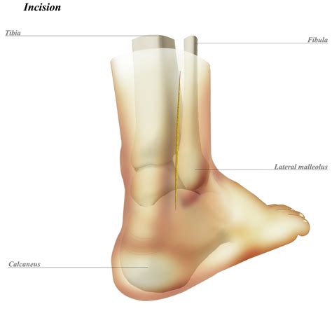 Lateral Malleolus