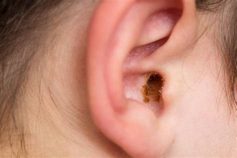 Why Do My Ears Feel Clogged? ENT Associates