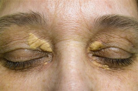 Xanthoma - Xanthelasma