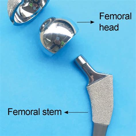 1 Metal on polyethylene total hip replacement. | Download Scientific Diagram