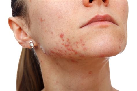 Acne Papules: Causes, Treatments, Natural Remedies, Do's and Don’ts