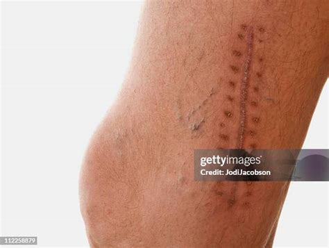 72 Knee Surgery Scar Stock Photos, High-Res Pictures, and Images ...