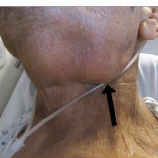 (PDF) Carotid Sinus Syndrome as a Manifestation of Head and Neck Cancer