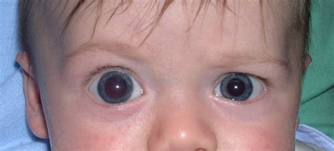 Risk Factors And Precautions For Primary Congenital Glaucoma - Ask The Nurse Expert