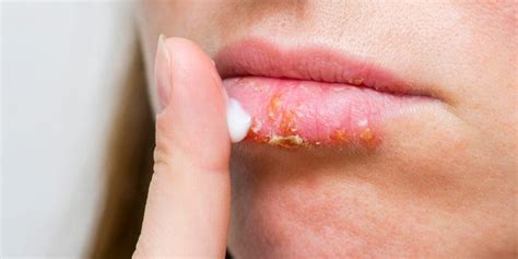 Sunburned Lips: How to Treat a Lip Burn