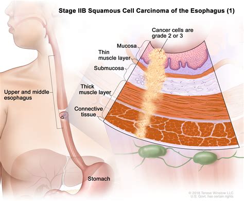 Esophageal Cancer Treatment - NCI