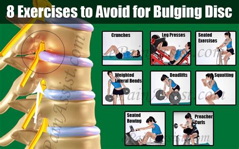 8 Exercises to Avoid for Bulging Disc | Bulging disc, Exercise, Bulging disc exercises