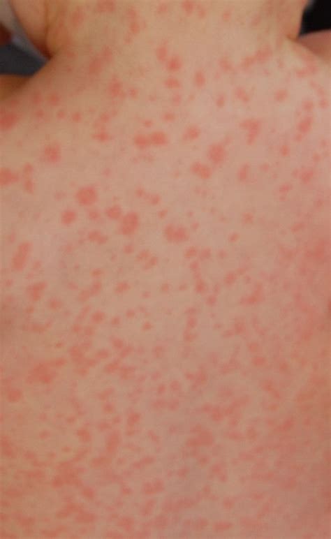 Amoxicillin Rash Pictures | Amoxicillin rash, Rashes remedies, Rash ...