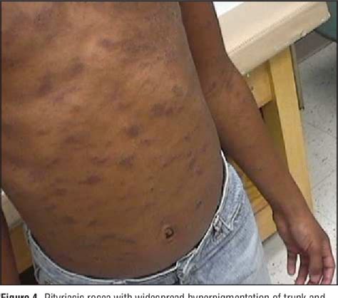 Pityriasis Rosea African American