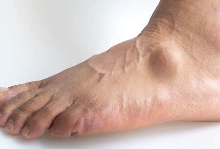 Lump On Top Of Foot: Common Causes & Treatment