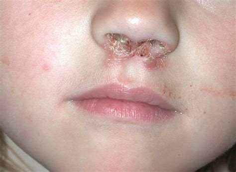 Impetigo, Contagious Skin Infection: Causes, Treatment, 52% OFF