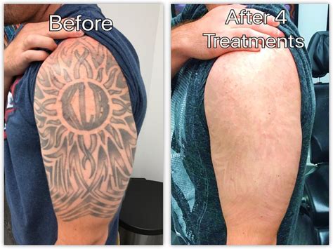 Green Tattoo Removal Before And After - Best Tattoo Ideas For Men & Women