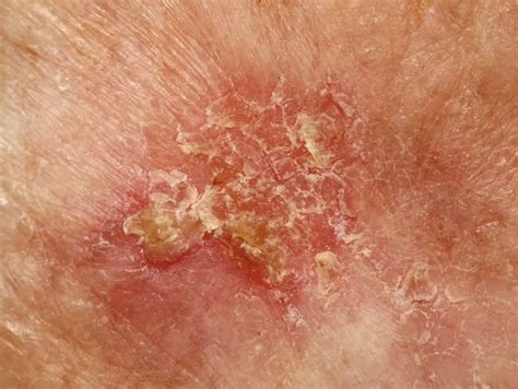 Perbedaan Keratosis Aktinik dengan Karsinoma Sel Skuamosa - Alomedika