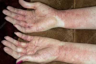 Allergic skin reaction to hand cream - Stock Image - C011/0339 - Science Photo Library