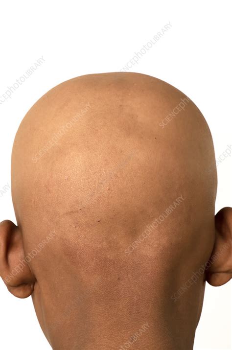 Alopecia totalis - Stock Image - C052/5443 - Science Photo Library