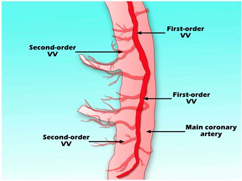 IJMS | Free Full-Text | Vasa Vasorum in Atherosclerosis and Clinical ...