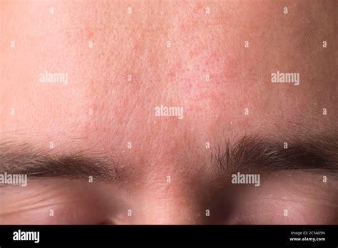 weeping eczema in the stage of exudation. Closeup of forehead area with eczema rash clinic Stock ...