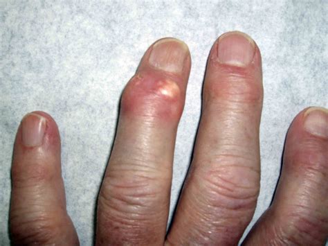 Gout (patient information) - wikidoc