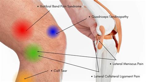 Knee Pain Location Chart | Learn the Pain Location of Knee Injuries