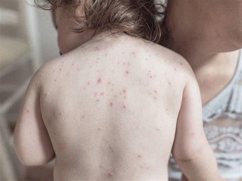 Red dots on skin: Pictures, causes, treatment, and when to seek help ...