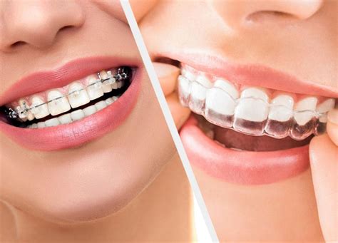 Orthodontics Treatment – Qualident Ağız Ve Diş Sağlığı Polikliniği