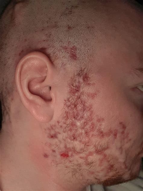 genital psoriasis or jock itch? : r/DermatologyQuestions