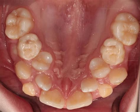 Hyperdontia - Treatment & Causes of Extra Teeth in the Mouth