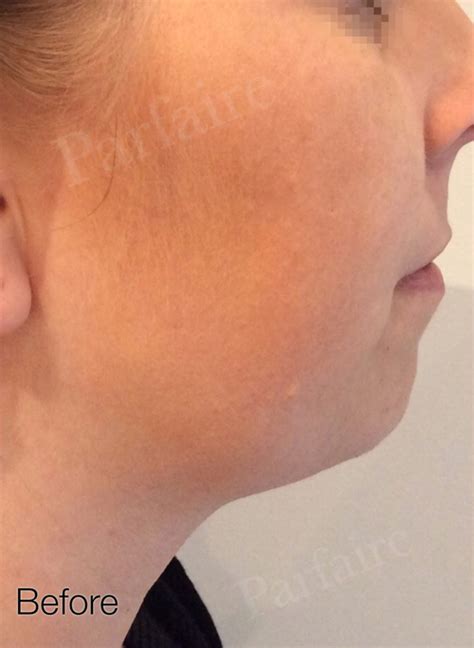 Kybella Double Chin Reduction & Treatment - Pasadena, CA