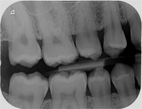 Types of Dental Radiographs and their Uses - dentalnotebook