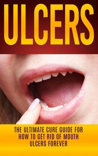 Buy Ulcers: The Ultimate Cure Guide for How to Get Rid of Mouth Ulcers Instantly (Ulcer Free ...