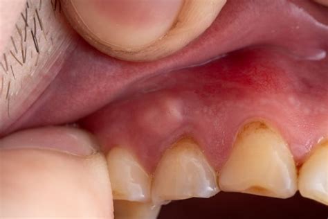 Why is There a Bump on My Gums? | Emergency Dentist in Irving