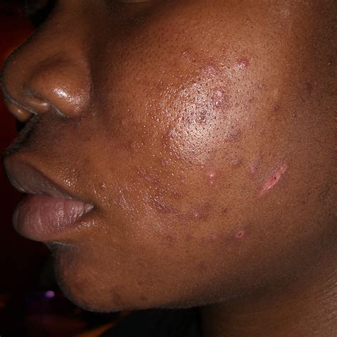 List 97+ Pictures Photos Of Lupus Rash On Face Excellent