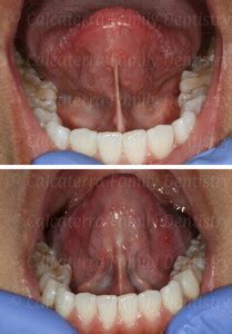 Laser Frenectomy and Tongue-Tie | Dentist Orange, Milford, West Haven