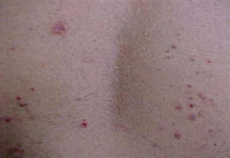 Figure From Cutaneous Tuberculosis In Hong Kong: An, 44% OFF