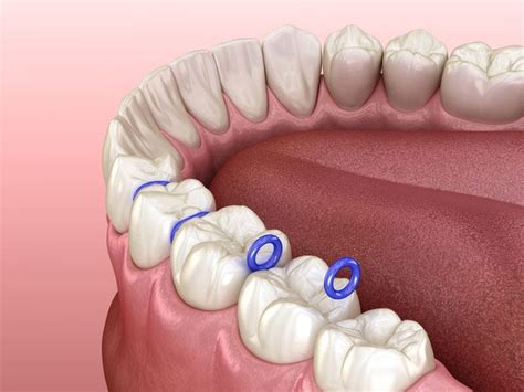 Why You Need Orthodontic Spacers - Koch Orthodontics