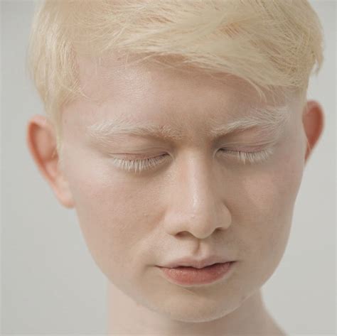 How are albinos different nationalities and races - Pictolic